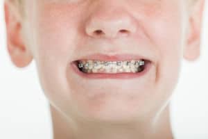 braces
